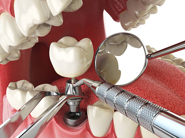 Best Emergency Tooth Extraction in Brodhead, KY